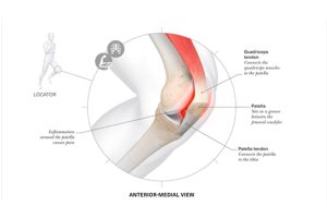 Lesiones-más-frecuentes-en-corredores-vitalmente-Imagen-003