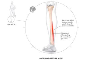 Lesiones-más-frecuentes-en-corredores-vitalmente-Imagen-005