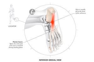 Lesiones-más-frecuentes-en-corredores-vitalmente-Imagen-006